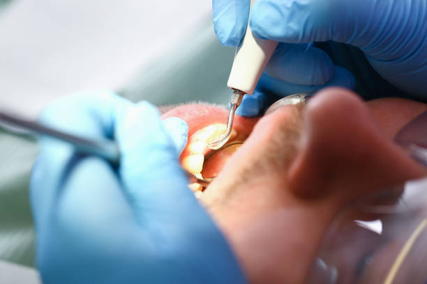 Best Emergency Broken Tooth Repair in North Lakeport, CA